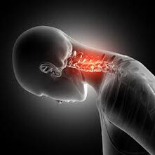 Servikal osteokondroz
