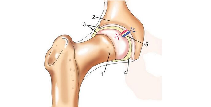 kalça eklemi ve artroz